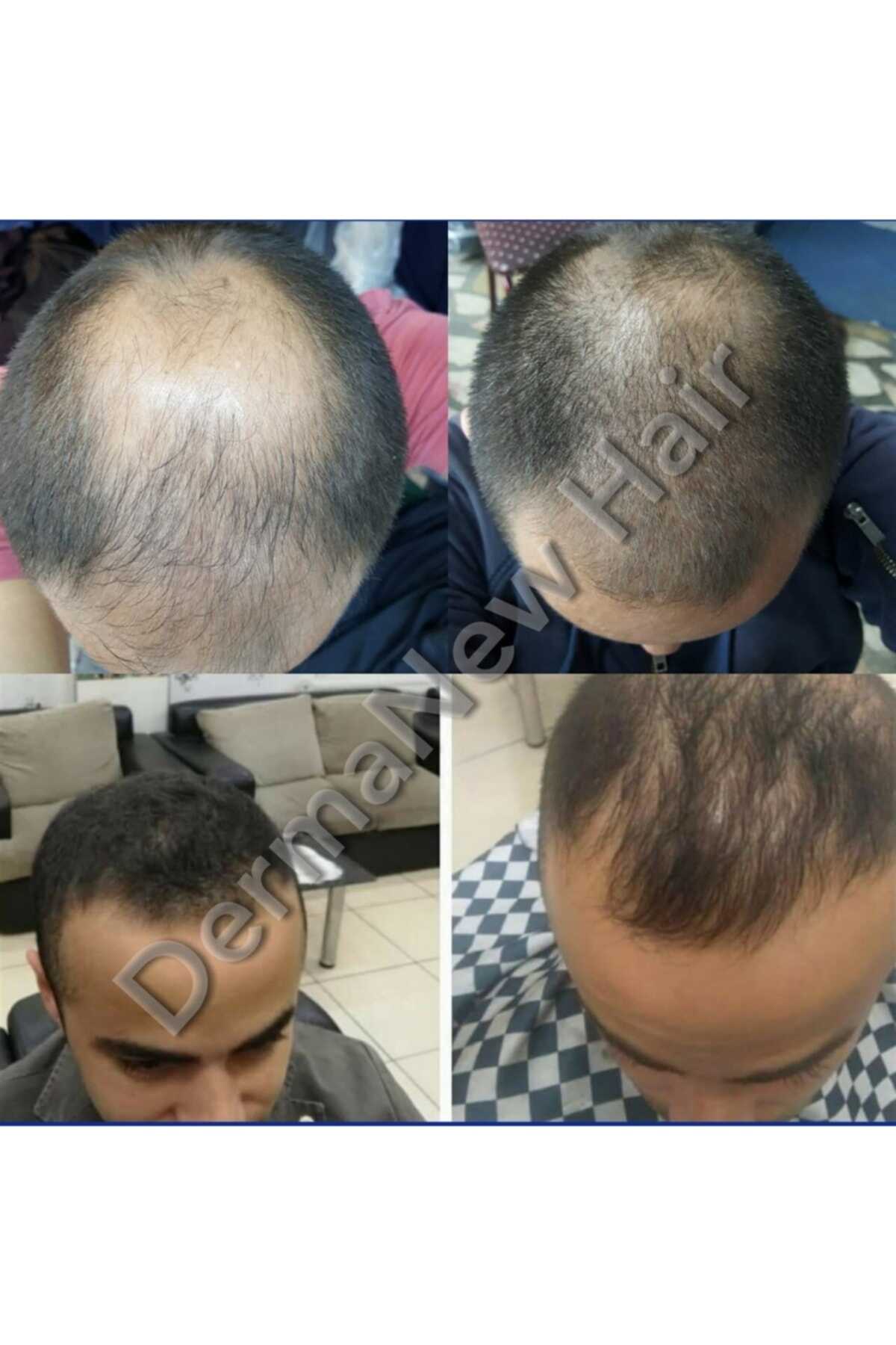 سرم تقویت کننده مو - رفع طاسی سر مردانه 50 میل همراه قطره چکان هدیه برند dermanew hair
